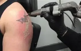 remoção de tatuagem a laser sp